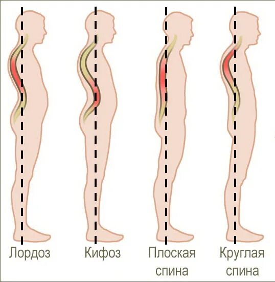 Усиленный лордоз. Искривление позвоночника кифоз и лордоз. Лордоз поясничного отдела и гиперлордоз. Сглажен лордоз в поясничном отделе позвоночника. Кифоз + лордоз поясничного отдела позвоночника.