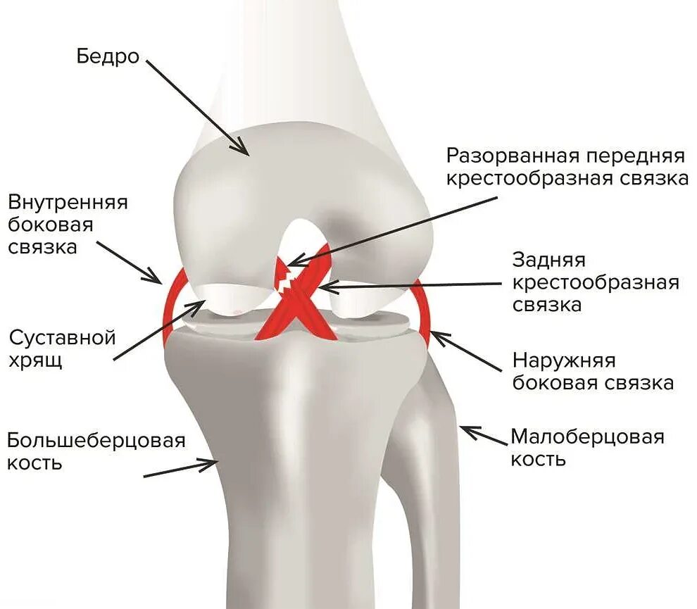 Крестообразные связки коленного сустава симптомы. Пкс коленного сустава анатомия. передняя крестообразная связка колена анатомия. разрыв крестообразной связки коленного сустава анатомия. разрыв передняя крестообразная связка коленного сустава анатомия.