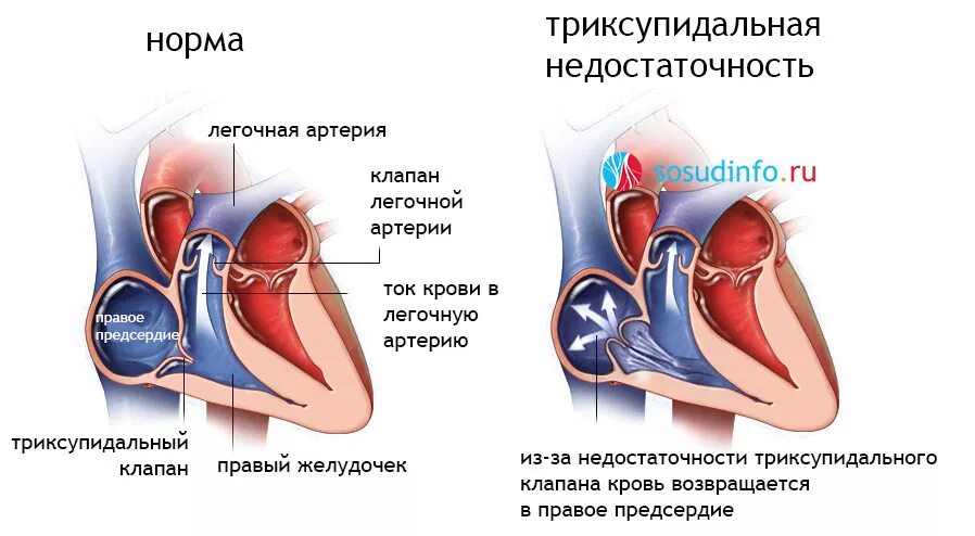 Недостаточность трехстворчатого клапана сердца. Регургитация 1 степени трикуспидального клапана. Трикуспидальная легочная регургитация 1ст. Недостаточность трехстворчатого клапана 1 степени.