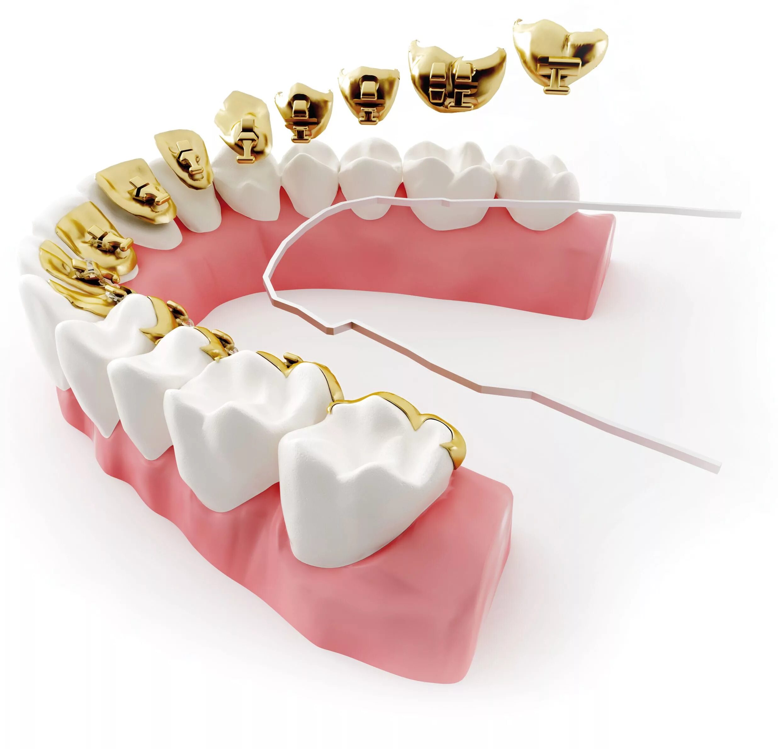 Ormco брекеты. Incognito брекеты. Внутренние лингвальные брекеты. Невидимые (лингвальные) брекеты. Лингвальная ортодонтия.