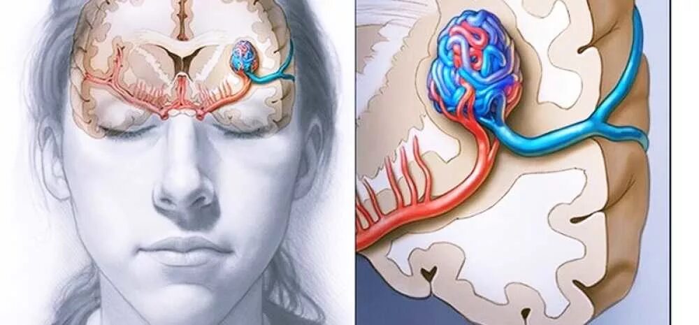 Аневризма мозга отзывы. Мальформация сосудов головного мозга. Мальформация артерий головного мозга. Мальформация сосудов мозга. Артериовенозная мальформация сосудов головного.