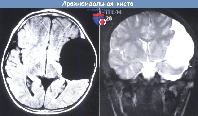 Киста головного мозга последствия. Ликворная киста головного мозга мрт. Арахноидальная киста мрт. Ретроцеребеллярная арахноидальная киста. Арахноидальная ликворная киста кт.