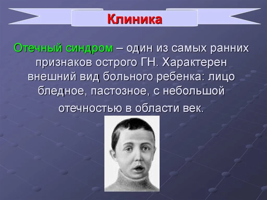 Выраженный отечный синдром. Для отечного синдрома, характерно:. один из ранних признаков.