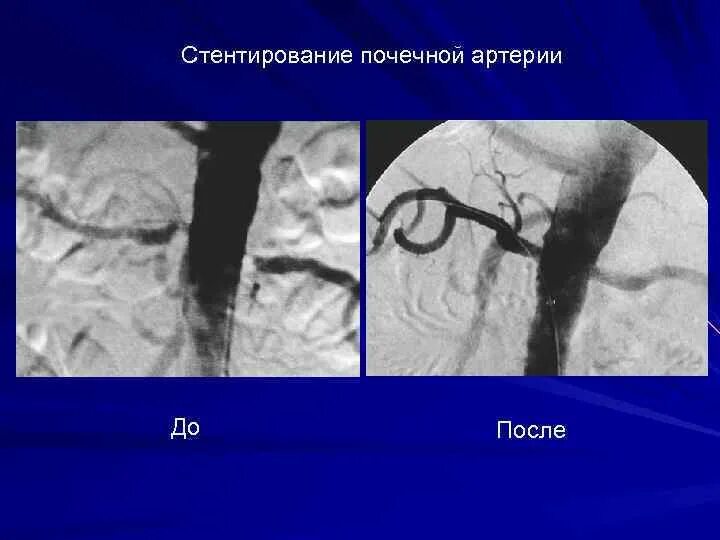 После стентирование самолет. Стентирование почечной артерии. Фибромускулярный стеноз почечной артерии. Стентирование сосудов почек. Ангиопластика почечных артерий.