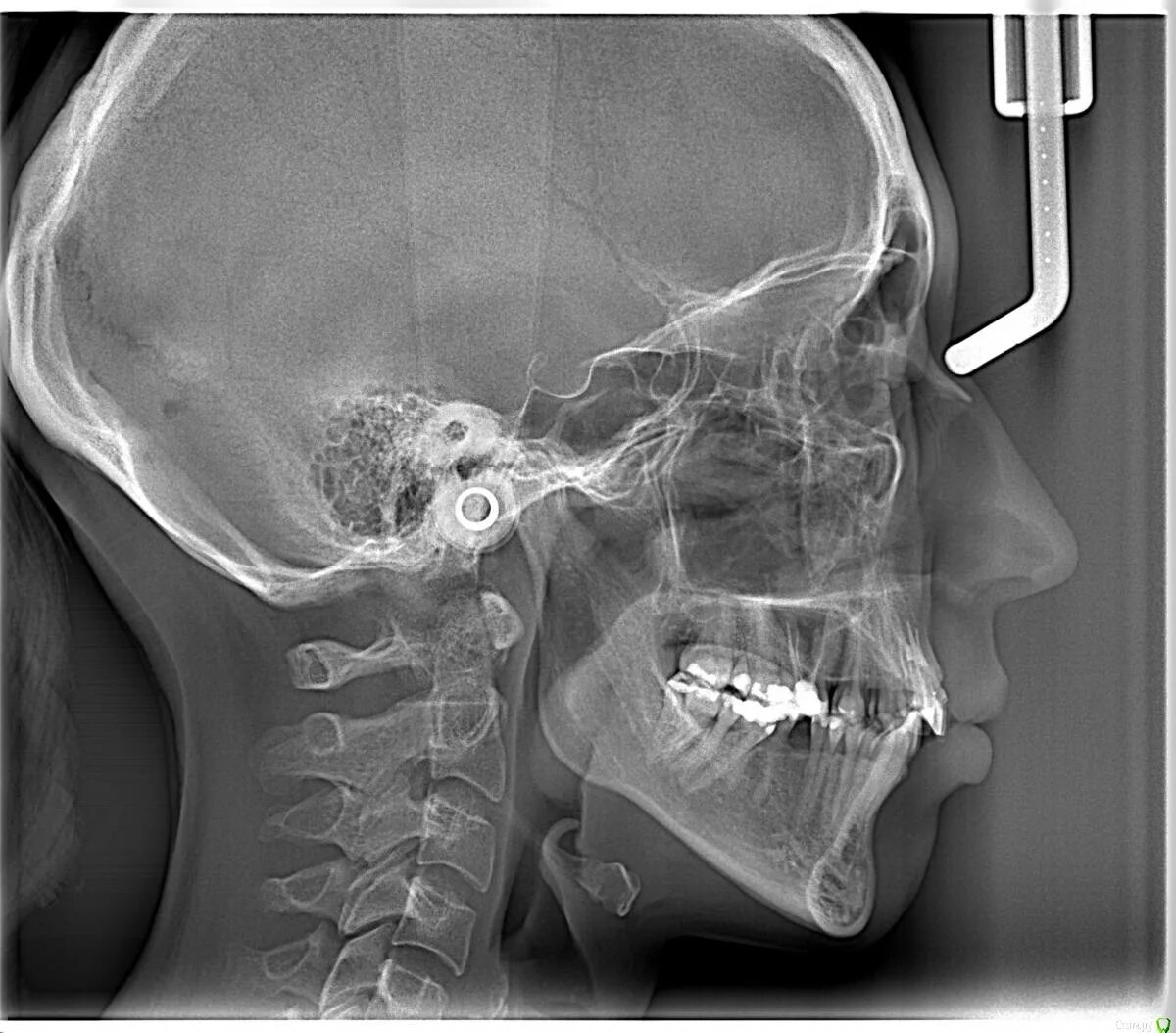 Снимок будут делать. ТРГ зубов (телерентгенограмма). ТРГ черепа в боковой проекции.