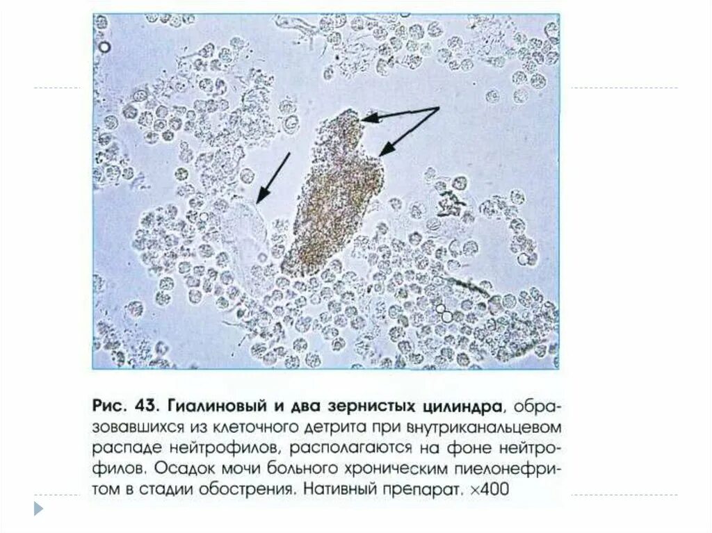 Повышенные цилиндры в моче. Гиалиновый цилиндр в осадке мочи. Микроскопическое исследование мочи цилиндры. Гиалиновые и зернистые цилиндры. Гиплиновые целинды в Мосе миуроскапия.