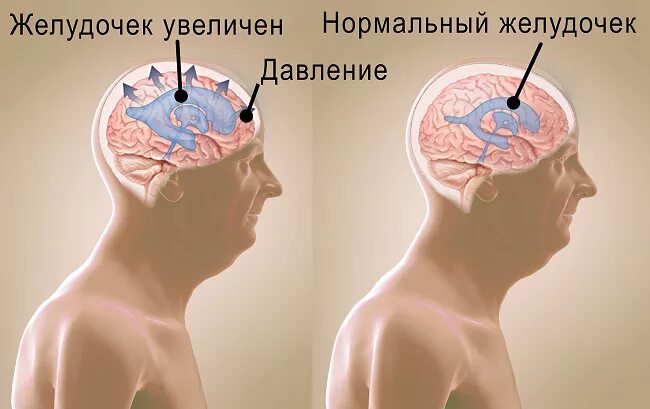 Клинические симптомы гидроцефалии. Шунтированная гидроцефалия. Шунт головной мозг ликвора. Давление Черепного мозга.