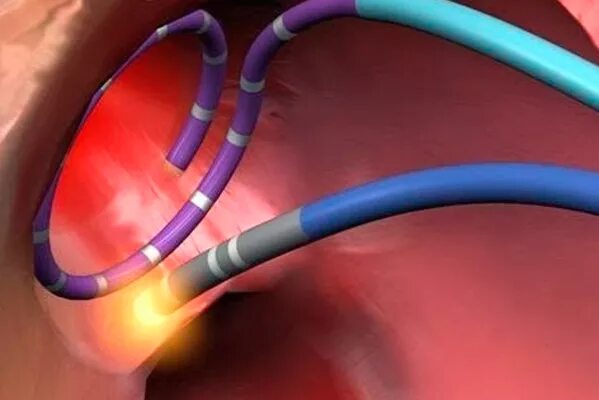 Радиочастотная катетерная абляция. Радиочастотная катетерная абляция (РЧА). Катетерная лазерная абляция. Изоляция легочных вен