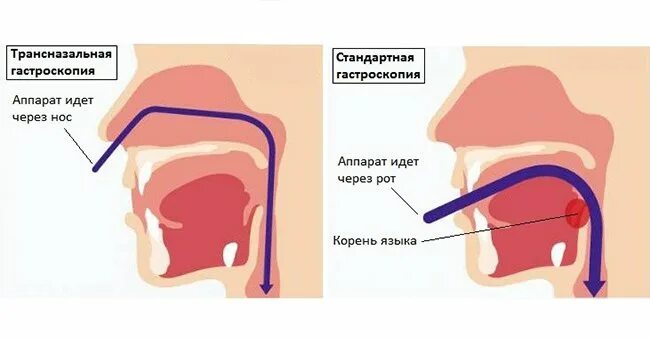 Трубка через рот. Трансназальный гастроскоп. Трансназальная гастроскопия.