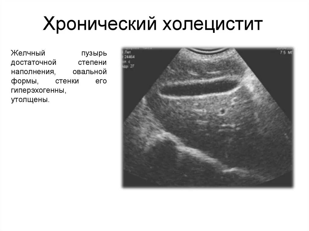 Желчный пузырь протокол