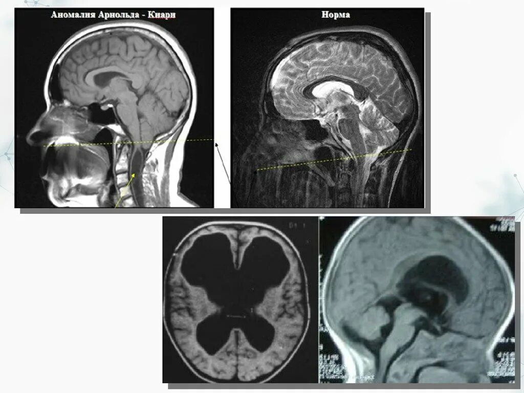 Триада Хакима Адамса нормотензивная гидроцефалия. Гидроцефалия головного мозга. Наружная гидроцефалия головного мозга мрт. Гидроцефалия головного мозга на кт.