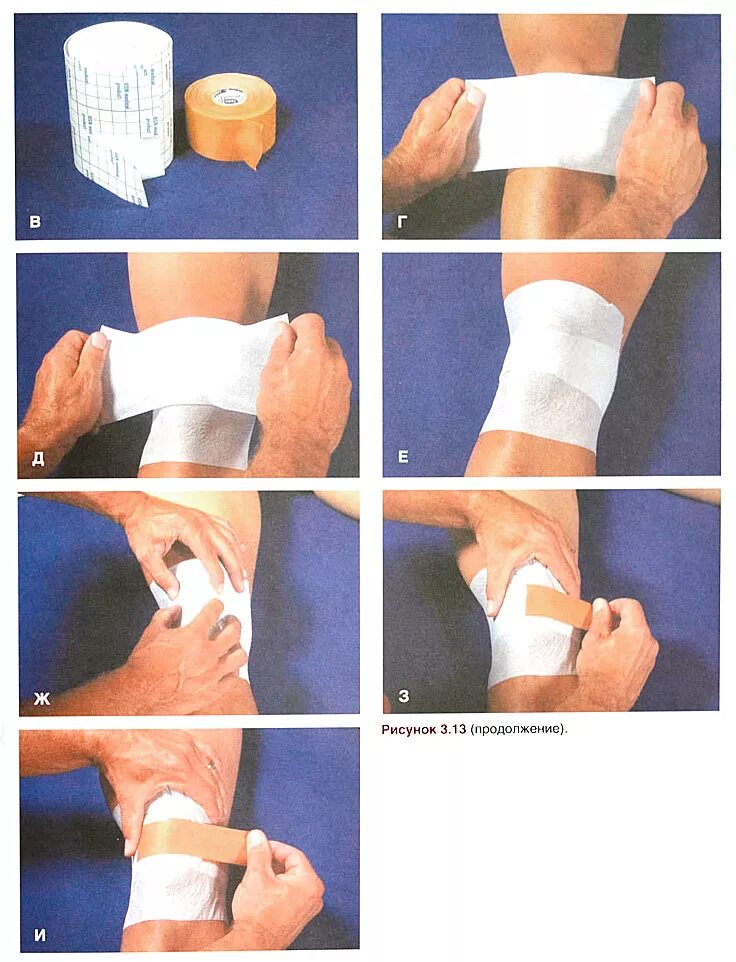 Перевязка эластичным бинтом. Схема бинтования коленного сустава эластичным бинтом. Бинтовка коленного сустава эластичным бинтом. Перевязка коленного сустава эластичным бинтом. Пластырь для коленного сустава