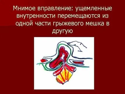 Вправление грыжи