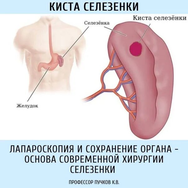 Симптомы селезенки у женщин. Паразитарная киста селезенки. Подкапсульная киста селезенки. Селезенка Гиста. Посттравматическая киста селезенки.