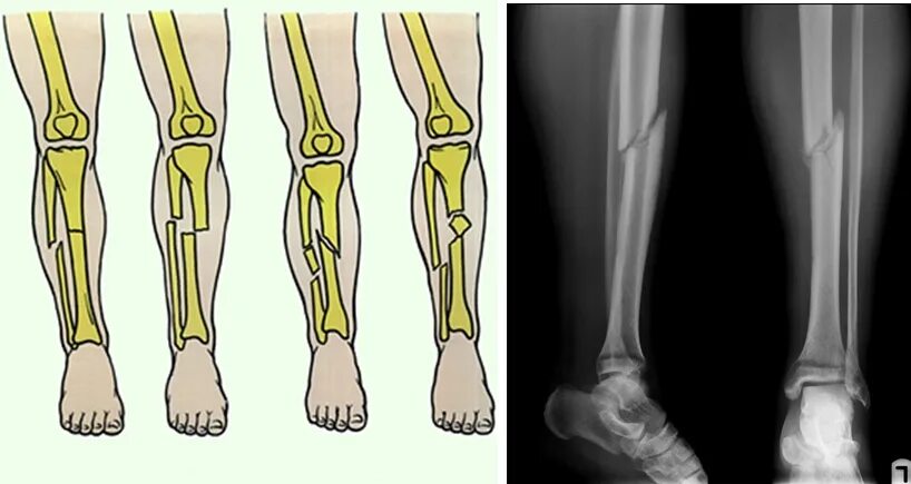 После операции на берцовой кости. Многооскольчатый перелом голени. Перелом диафиза большой берцовой кости. Косой перелом большеберцовой кости. Перелом нижней трети диафиза малоберцовой кости.