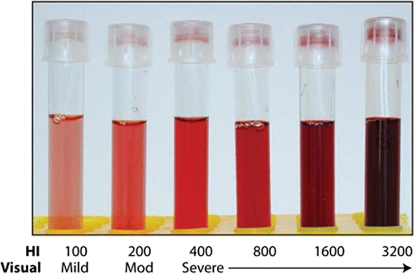 Кровь разного цвета. Гемолиз эритроцитов лаковая кровь. Гемолиз эритроцитов в пробирке. Гемолизированная сыворотка.