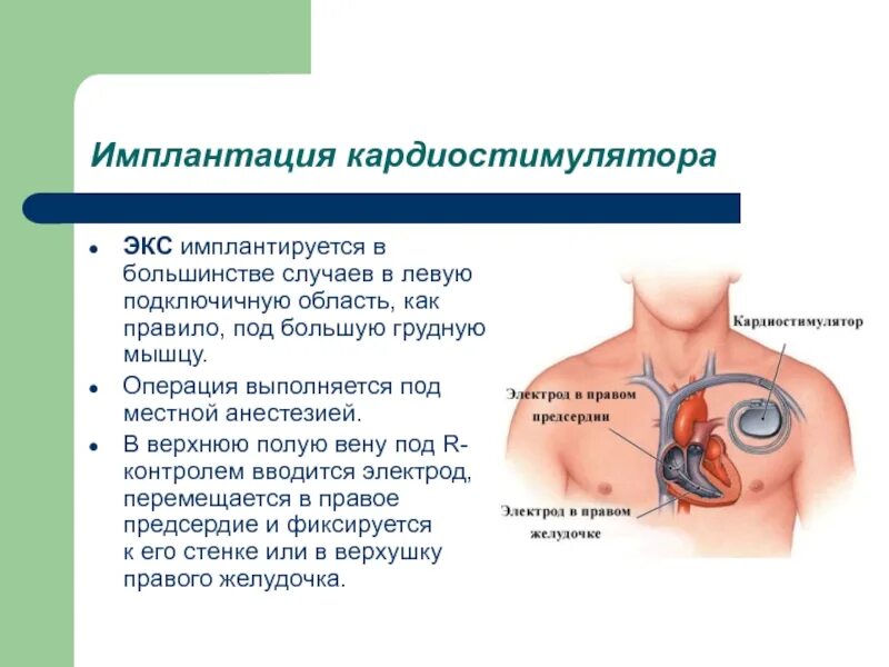 Искусственный водитель ритма