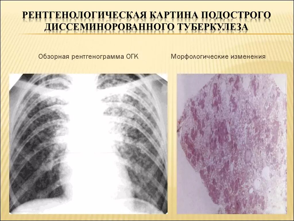 Диссеминированный туберкулез легких фазы. Подострый диссеминированный туберкулез рентген. Милиарный диссеминированный туберкулез рентген. Лимфогенный диссеминированный туберкулез рентген. Подострый милиарный туберкулез.