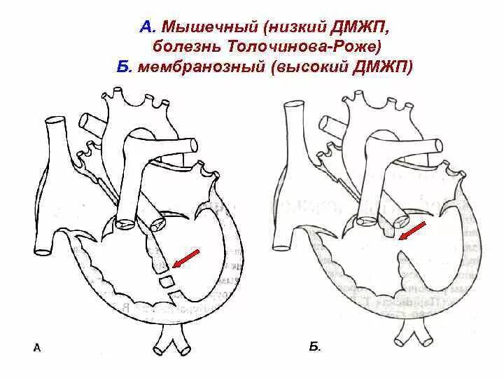 Мышечный дефект. Мышечный дефект