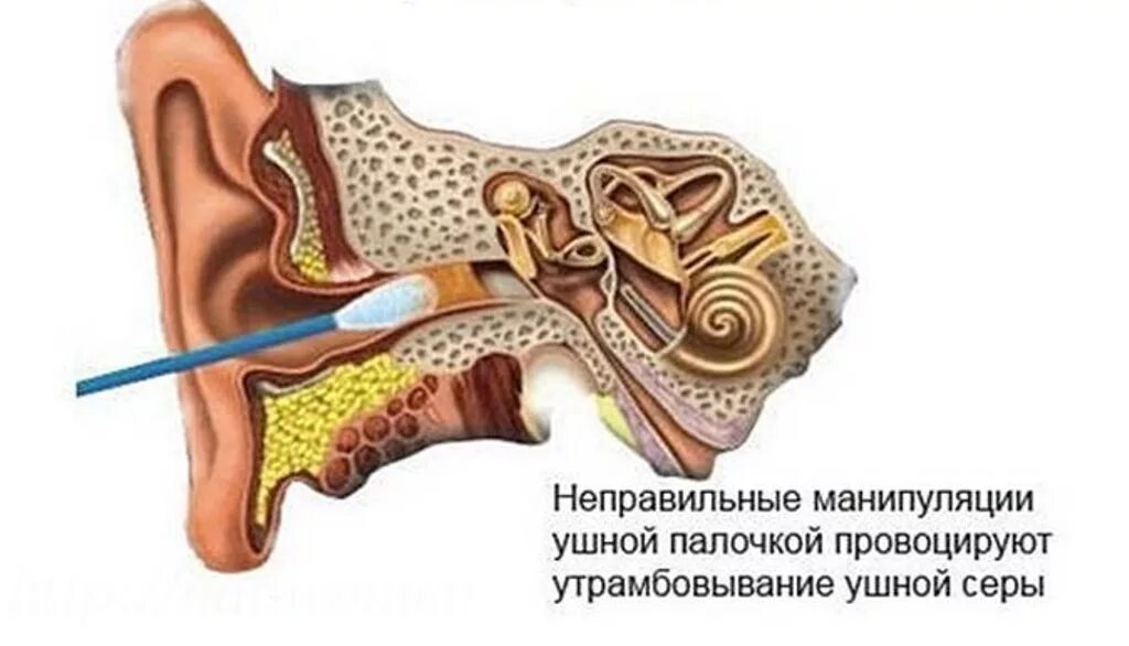 Ухо заложило после чистки палочкой