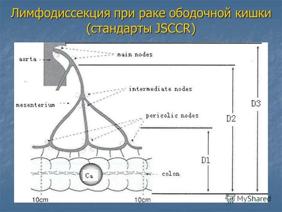 Лимфодиссекция при раке. Уровни лимфодиссекции толстой кишки. Лимфодиссекция в онкологии. Лимфатические узлы толстой кишки схема. Лимфатические узлы прямой кишки.