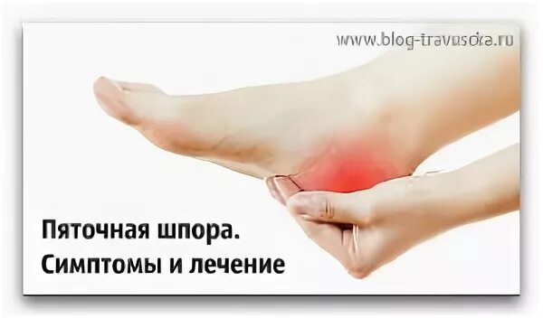 Синдром шпора пяточная. Синдром шпора пяточная