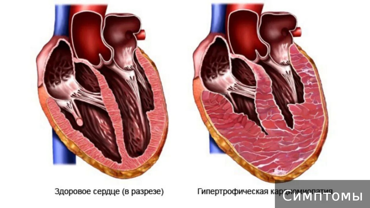 Гипертрофическая кардиопатия. Гипертрофия миокарда, Бычье сердце. Бычье сердце кардиомиопатия. Миокард левого предсердия