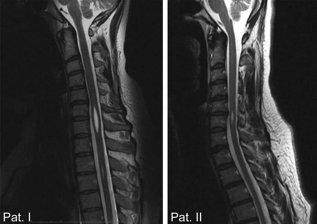 Гидромиелия сирингомиелия. Сирингомиелия грудного отдела позвоночника. Гидромиелия грудного отдела позвоночника мрт. Сирингомиелия грудного отдела мрт позвоночника.