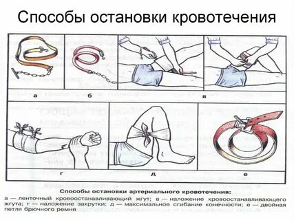 Схема остановки кровотечения