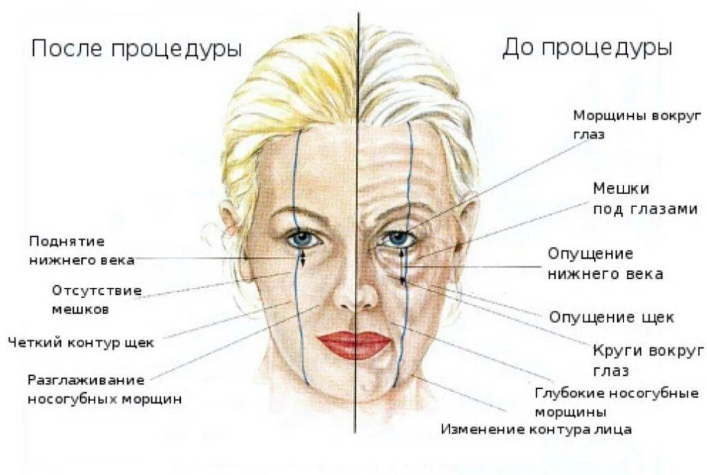 Куда колят ботокс. Мышцы лица анатомия для косметологов для ботокса. схемы куда колоть ботулакс. схема лица мышцы ботокс. куда можно колоть ботокс на лице схема.