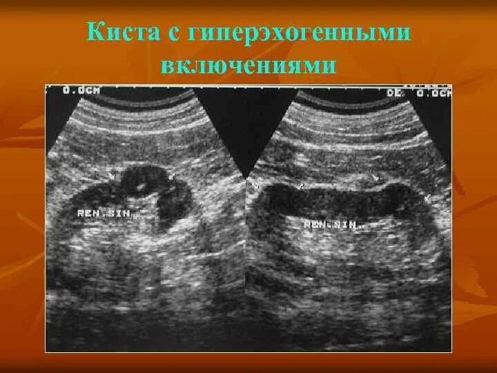 Синдром гиперэхогенных пирамидок почек на узи. Паренхима почки на узи. Анэхогенные структуры. Гиперэхогенные структуры на узи печени. Гиперэхогенные включения в селезенке на узи.