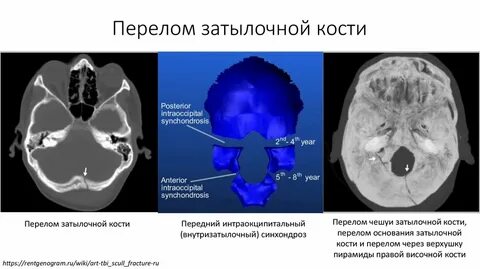Перелом затылочной кости