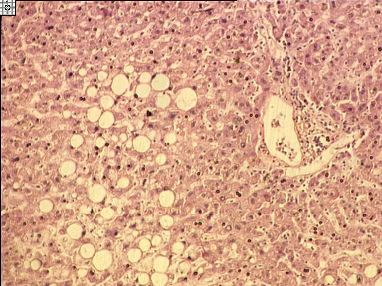 Токсическая дистрофия печени. Жировые дистрофии патанатомия. Жировой гепатоз печени патанатомия. Жировая дистрофия печени препарат патанатомия. Зернистая дистрофия патанатомия.