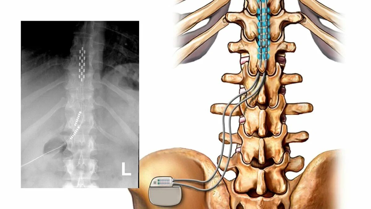 Спинальный нейростимулятор. Эпидуральный стимулятор спинного мозга. Спинальная нейростимуляция. Электроды в позвоночник.