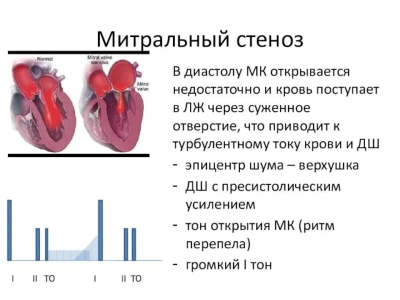 1 Тон сердца при митральном стенозе. Митрального стеноза границы. Тоны сердца при митральном стенозе. Механизм стеноза митрального клапана. Сердечная недостаточность митрального клапана