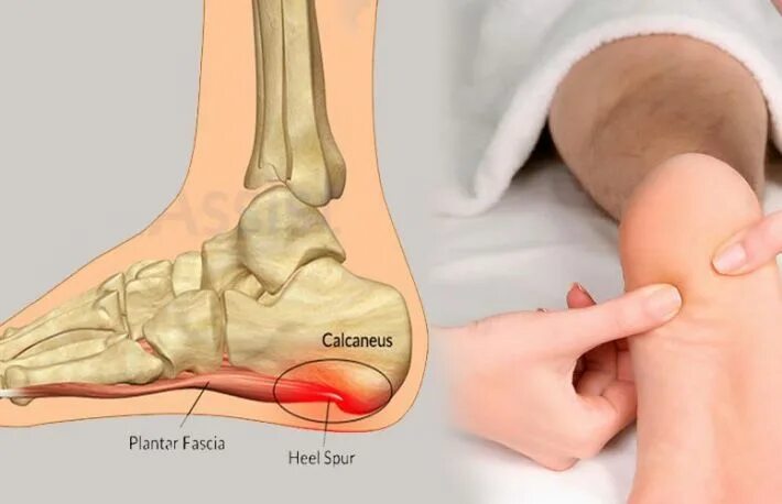 Плантарный фасциит мкб 10. Пяточный шип. Остроконечные остеофиты пяточной кости. Пяточный шип. Пяточная шпора костный нарост.