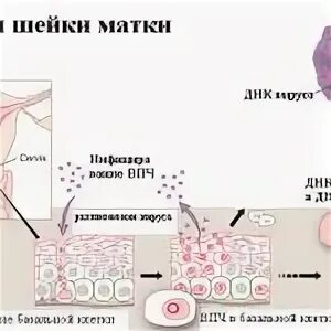 Умеренная дисплазия шейки матки что это. Дисплазия шейки матки 1. Дисплазия шейки матки степени.