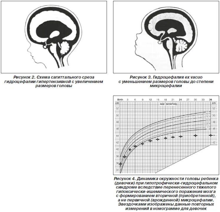 Диета при гидроцефалии мозга. Голова ребенка с гидроцефалией. Окружность головы плода при гидроцефалии. Объем головы при гидроцефалии у детей. Гидроцефальный синдром окружность головы.