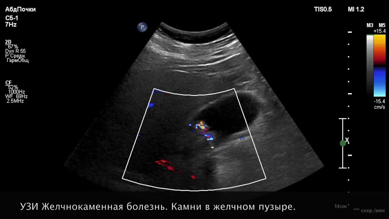 Узи сократимости желчного пузыря. Патология желчного пузыря на УЗИ. Желчнокаменная болезнь УЗИ. УЗИ признаки желчекаменной болезни.