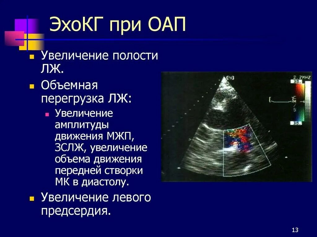Детское эхо сердца. Открытый артериальный проток у взрослых на эхокг. открытый артериальный проток у детей узи. открытый боталлов проток эхокг. эхокг при открытом артериальном протоке.