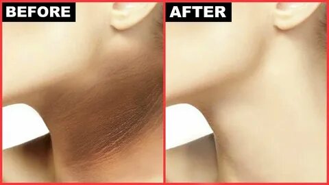 Neck black