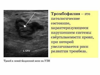 Тромбофилия это