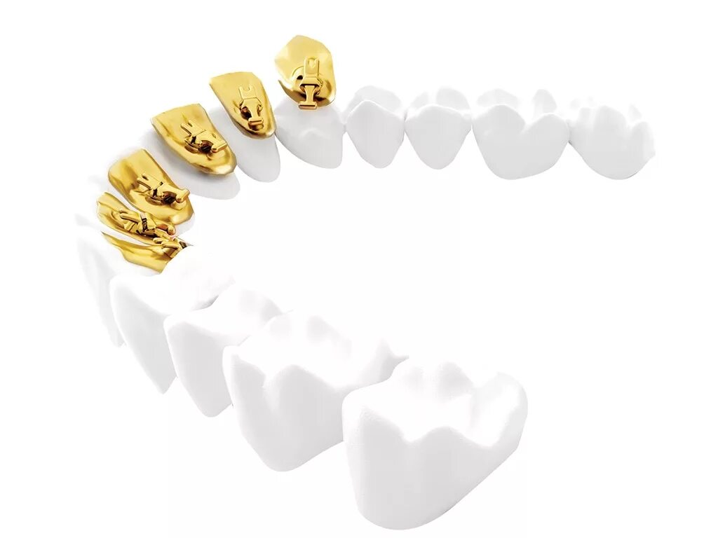 Брекеты инкогнито. Брекеты инкогнито. Лингвальные брекеты инкогнито. Брекеты incognito распаковка. Incognito брекеты.