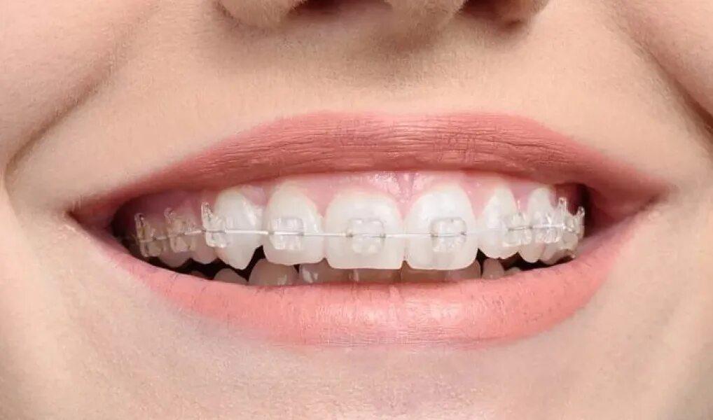 Сколько стоят брекеты в самаре. Сапфировые брекеты inspire ice. сапфировые брекеты radiance.
