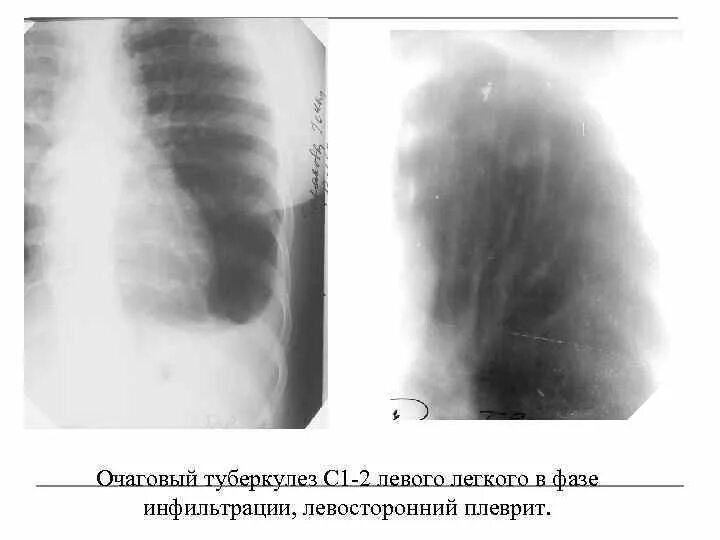 Туберкулез легких в фазе инфильтрации. Мягкоочаговый туберкулез. Туберкулез верхушки легкого. Очаговый туберкулез верхушки левого легкого схема. Очаговый туберкулез 1-2 сегментов левого легкого.