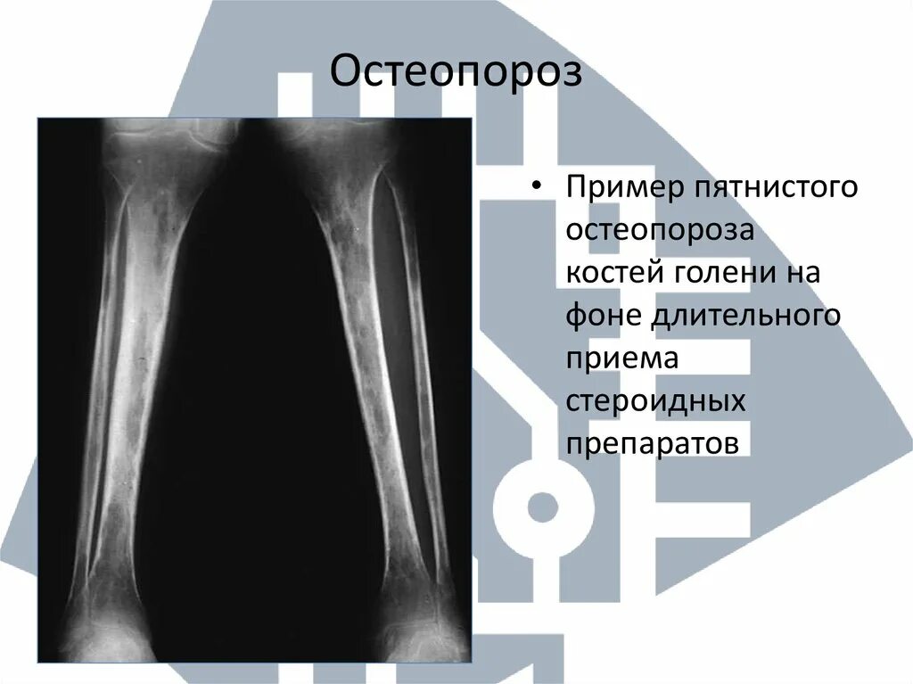 Остеопороз голени