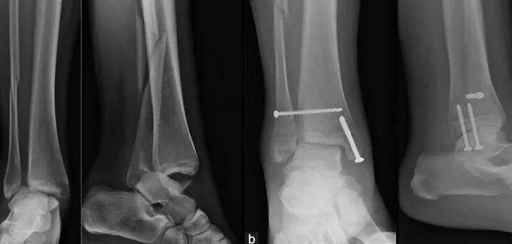 Дистальный разрыв. Остеосинтез межберцового синдесмоза. Перелом лодыжки синдесмоз. Межберцовый синдесмоз голеностопного сустава рентген. Перелом Мезоннева лодыжки.
