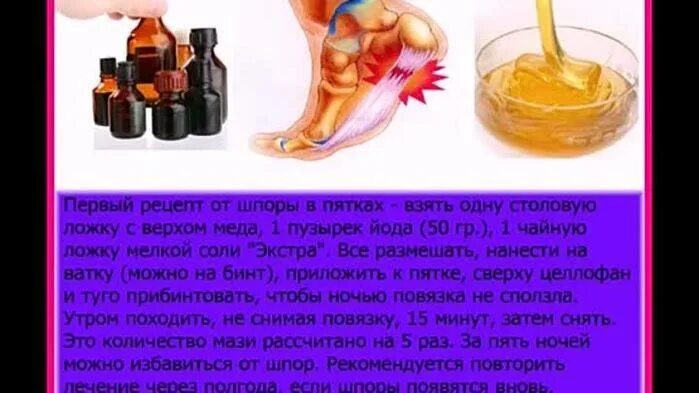 Как народными средствами вылечить шпору на пятке