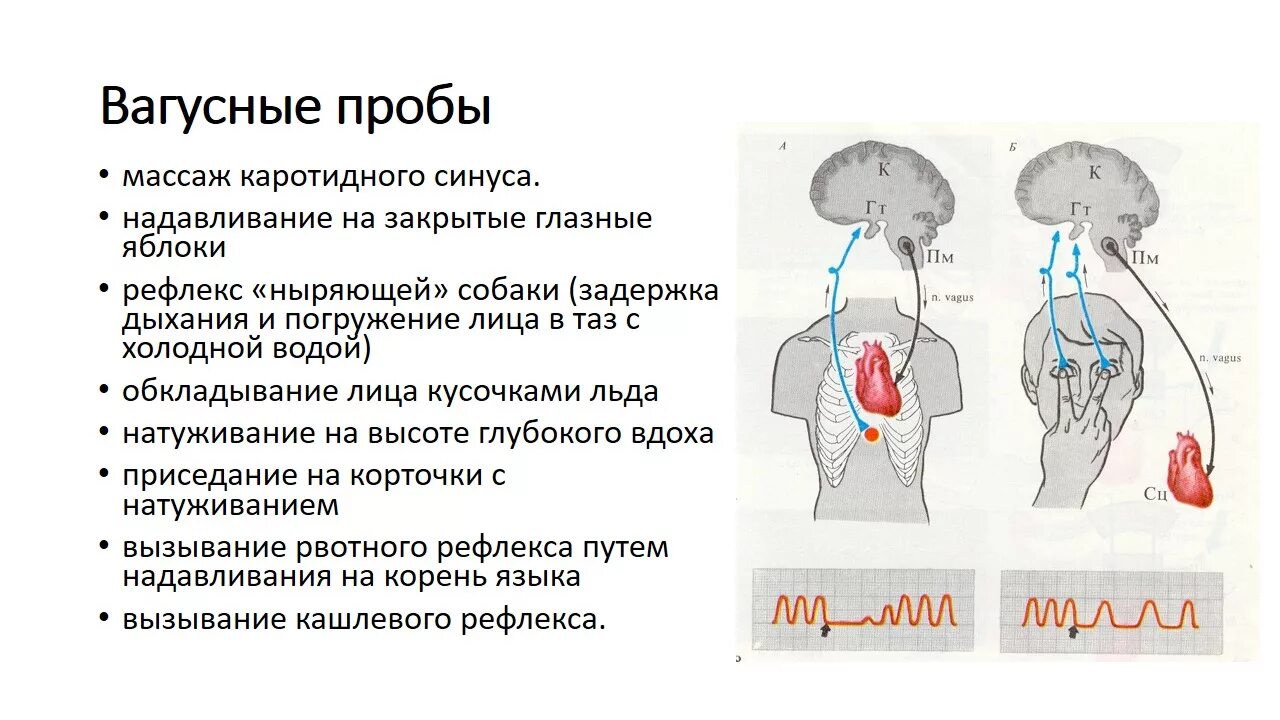 Проба с массажем каротидного синуса. Вагусные пробы при тахикардии. Вагусные рефлекторные пробы. Вагусные пробы при аритмии.