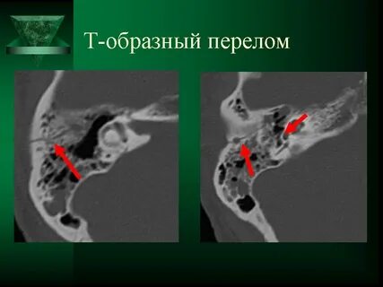 Симптомы продольного перелома височной кости